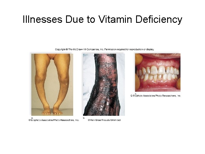 Illnesses Due to Vitamin Deficiency 