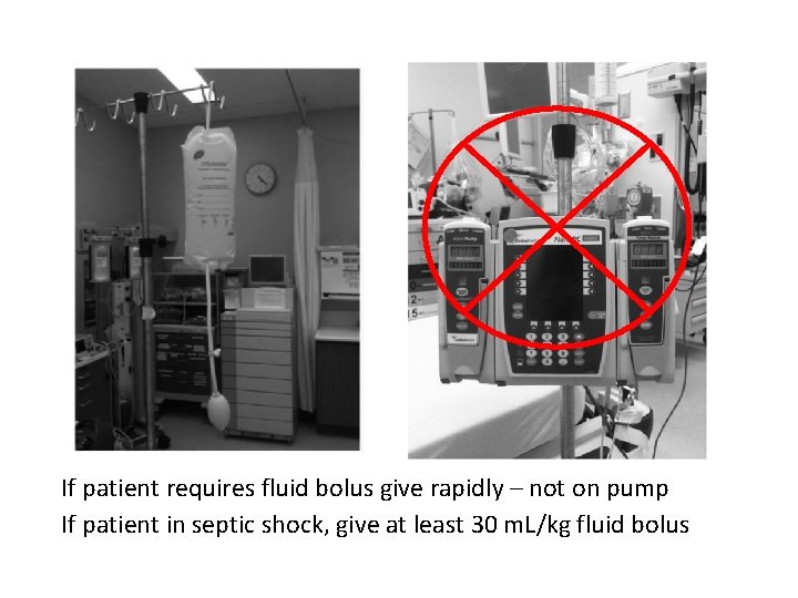 If patient requires fluid bolus give rapidly – not on pump If patient in