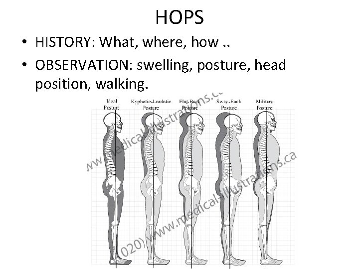 HOPS • HISTORY: What, where, how. . • OBSERVATION: swelling, posture, head position, walking.