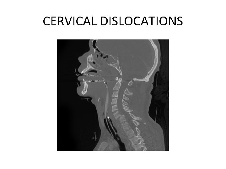 CERVICAL DISLOCATIONS 