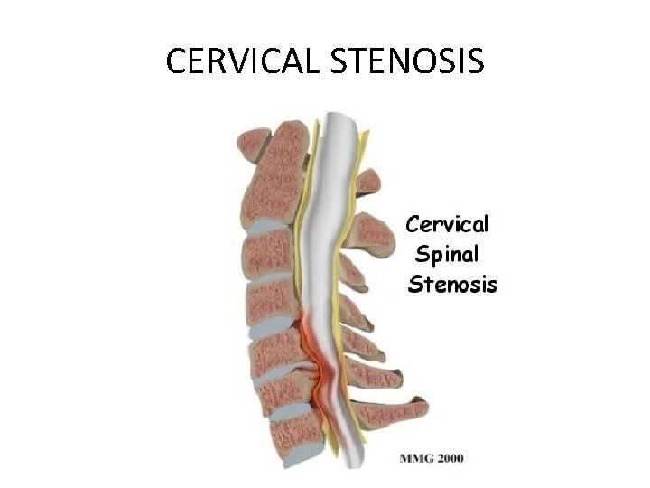 CERVICAL STENOSIS 