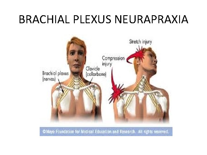 BRACHIAL PLEXUS NEURAPRAXIA 