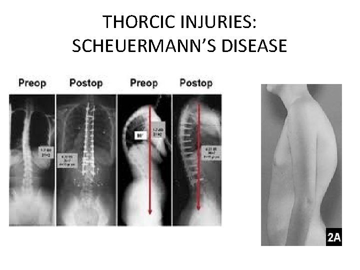 THORCIC INJURIES: SCHEUERMANN’S DISEASE 