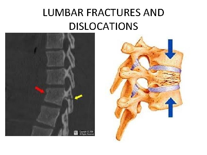 LUMBAR FRACTURES AND DISLOCATIONS 