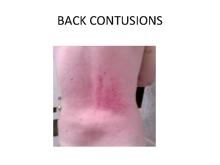 BACK CONTUSIONS 