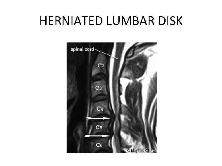 HERNIATED LUMBAR DISK 