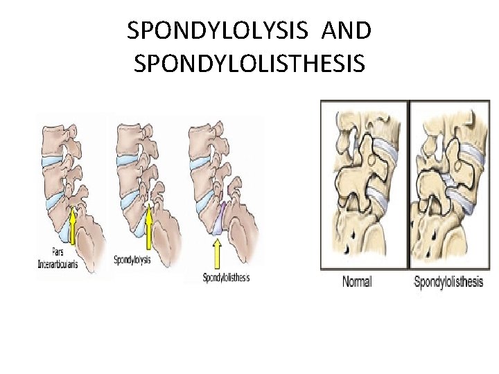 SPONDYLOLYSIS AND SPONDYLOLISTHESIS 