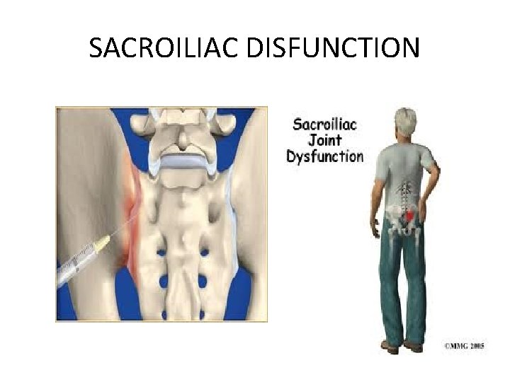SACROILIAC DISFUNCTION 