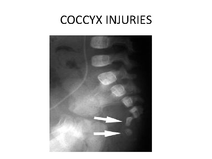 COCCYX INJURIES 