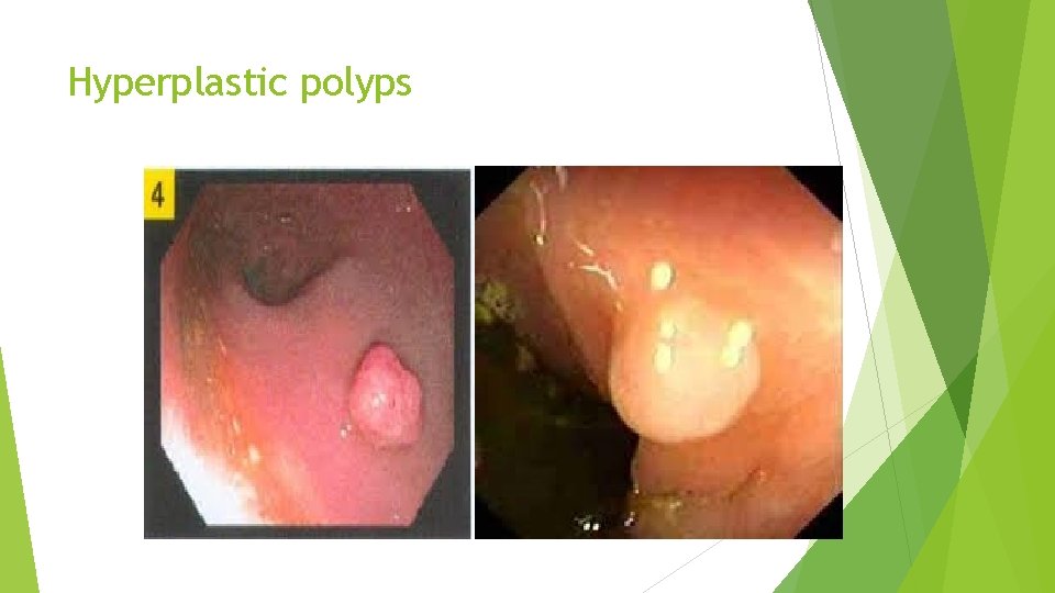 Hyperplastic polyps 