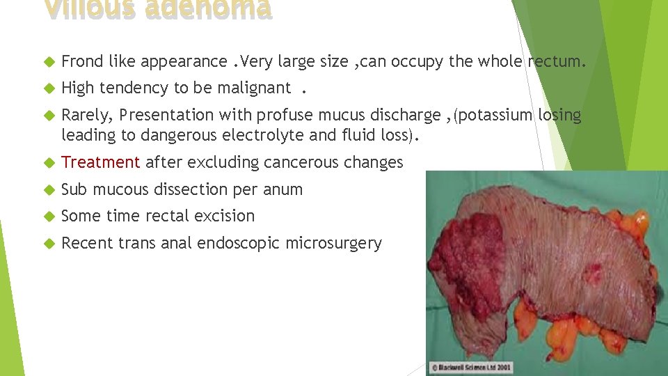 Villous adenoma Frond like appearance. Very large size , can occupy the whole rectum.