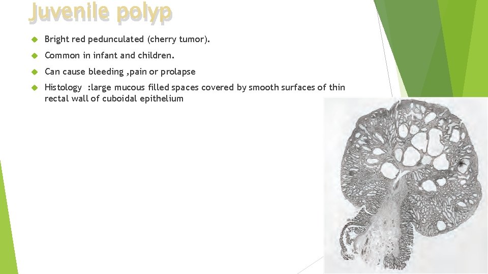 Juvenile polyp Bright red pedunculated (cherry tumor). Common in infant and children. Can cause