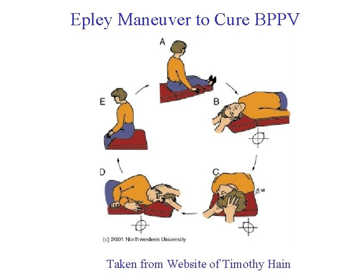 Epley Maneuver to Cure BPPV Taken from Website of Timothy Hain 