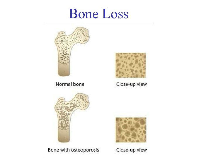 Bone Loss 