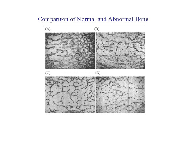 Comparison of Normal and Abnormal Bone 