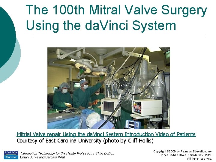 The 100 th Mitral Valve Surgery Using the da. Vinci System Mitrial Valve repair