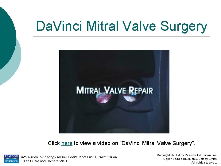 Da. Vinci Mitral Valve Surgery Click here to view a video on “Da. Vinci
