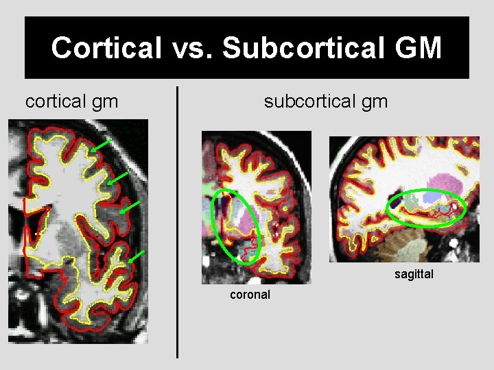 Cortical vs. Subcortical GM cortical gm subcortical gm sagittal coronal 