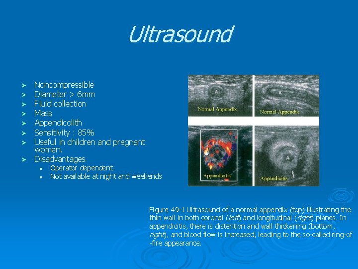 Ultrasound Noncompressible Diameter > 6 mm Fluid collection Mass Appendicolith Sensitivity : 85% Useful Ultrasound Noncompressible Diameter > 6 mm Fluid collection Mass Appendicolith Sensitivity : 85% Useful
