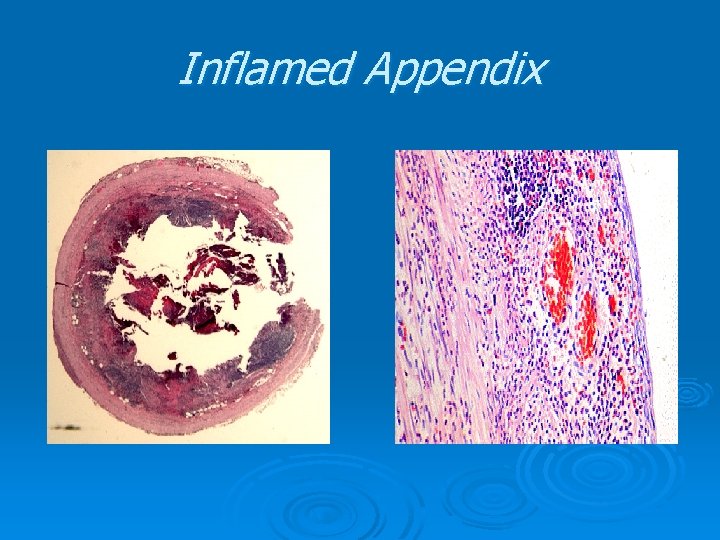 Inflamed Appendix Inflamed Appendix