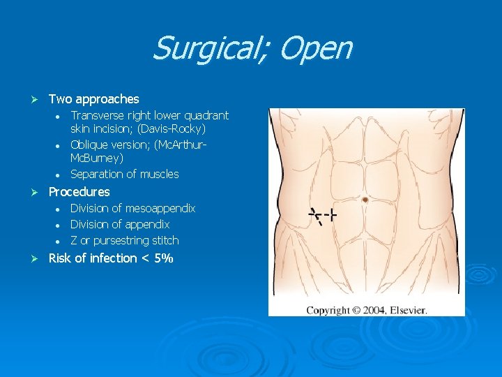 Surgical; Open Ø Two approaches l l l Ø Procedures l l l Ø Surgical; Open Ø Two approaches l l l Ø Procedures l l l Ø