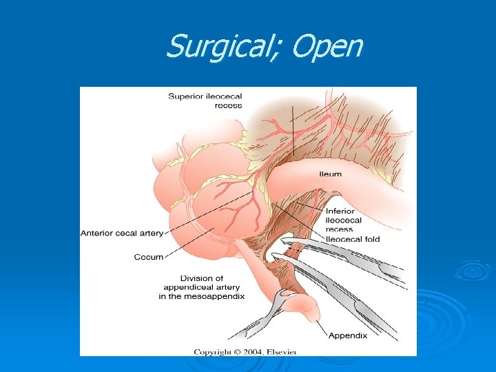 Surgical; Open Surgical; Open