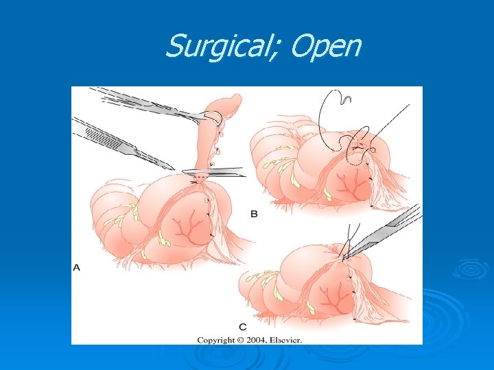 Surgical; Open Surgical; Open