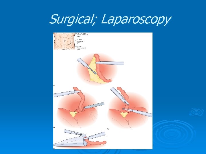 Surgical; Laparoscopy Surgical; Laparoscopy