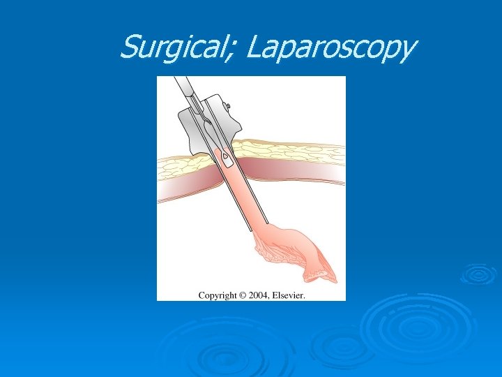 Surgical; Laparoscopy Surgical; Laparoscopy