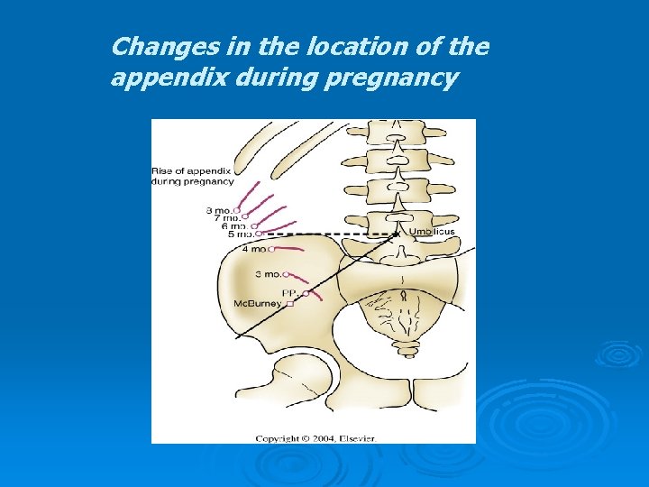 Changes in the location of the appendix during pregnancy Changes in the location of the appendix during pregnancy
