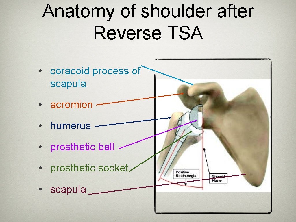 Anatomy of shoulder after Reverse TSA • coracoid process of scapula • acromion •