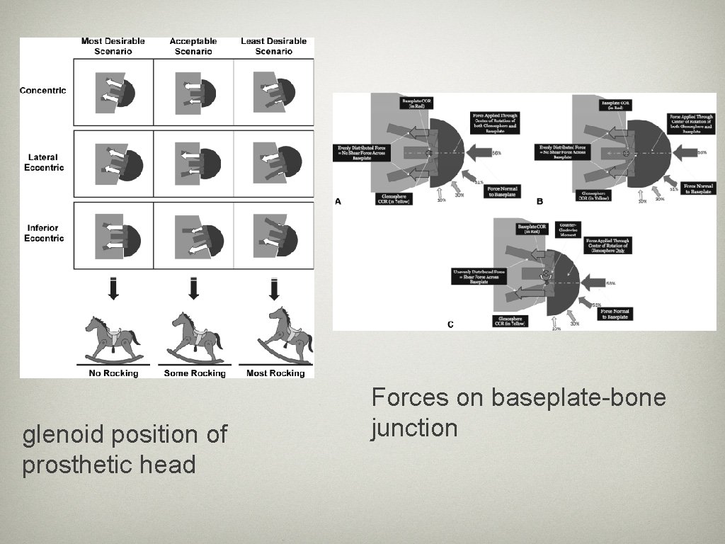 glenoid position of prosthetic head Forces on baseplate-bone junction 