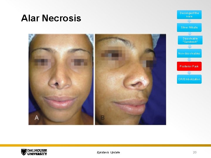 Decongest the nose Alar Necrosis Silver Nitrate Dissolvable "Sandwich" Non-dissolvables Posterior Pack OR/Embolization Epistaxis