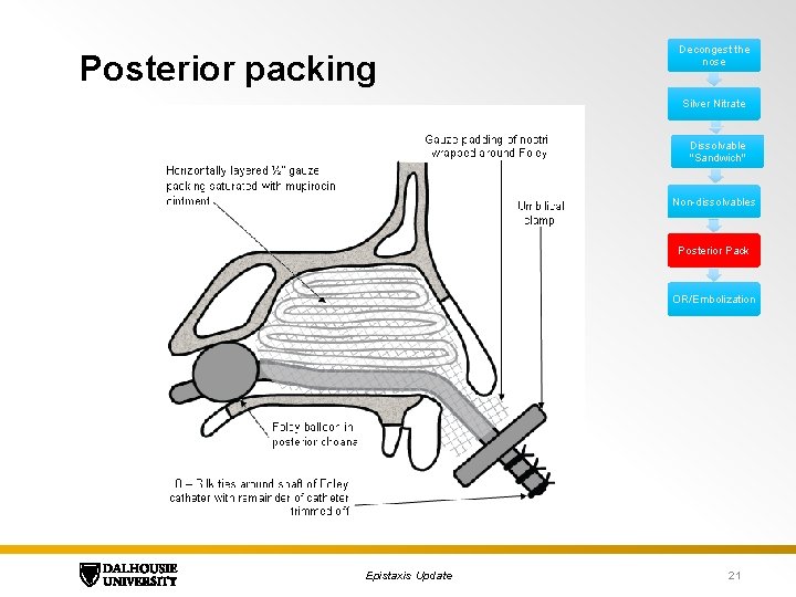 Posterior packing Decongest the nose Silver Nitrate Dissolvable "Sandwich" Non-dissolvables Posterior Pack OR/Embolization Epistaxis
