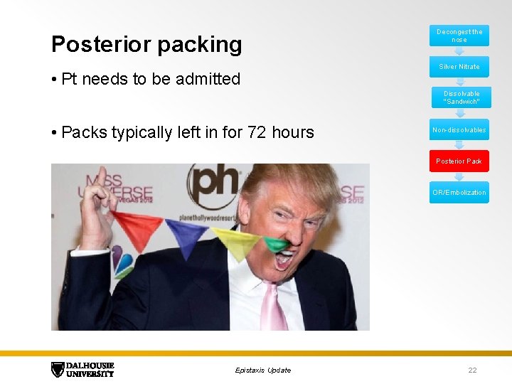 Posterior packing • Pt needs to be admitted Decongest the nose Silver Nitrate Dissolvable