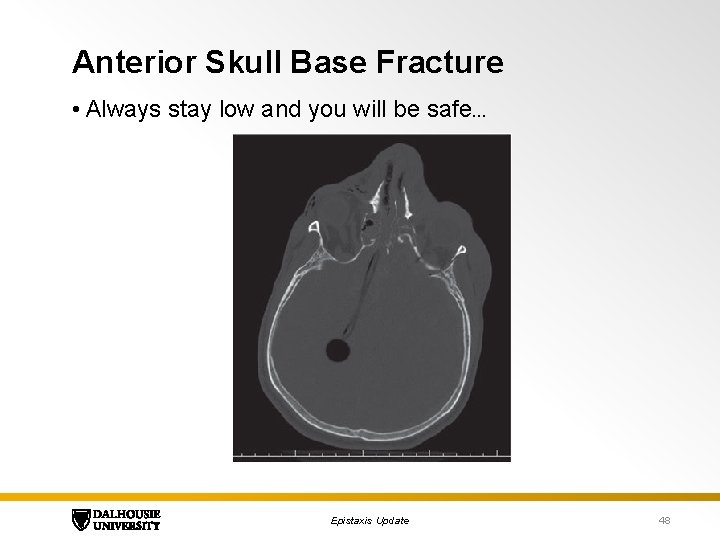 Anterior Skull Base Fracture • Always stay low and you will be safe… Epistaxis