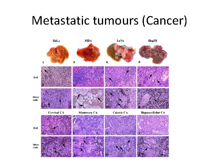 Metastatic tumours (Cancer) 