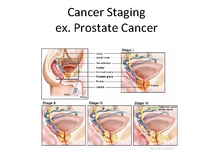 Cancer Staging ex. Prostate Cancer 