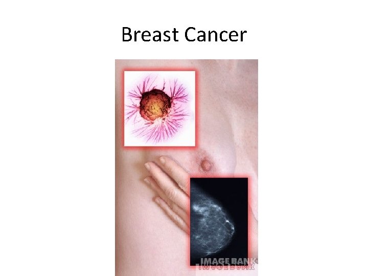 Breast Cancer 