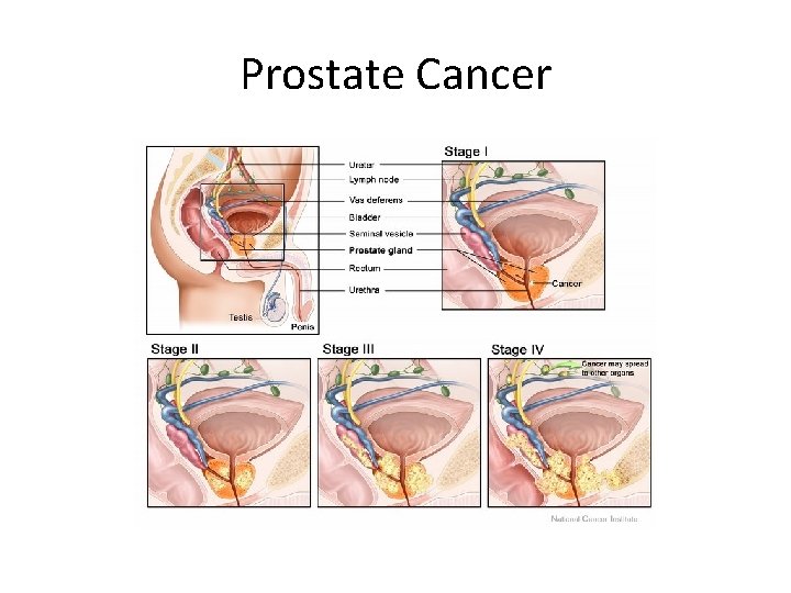 Prostate Cancer 