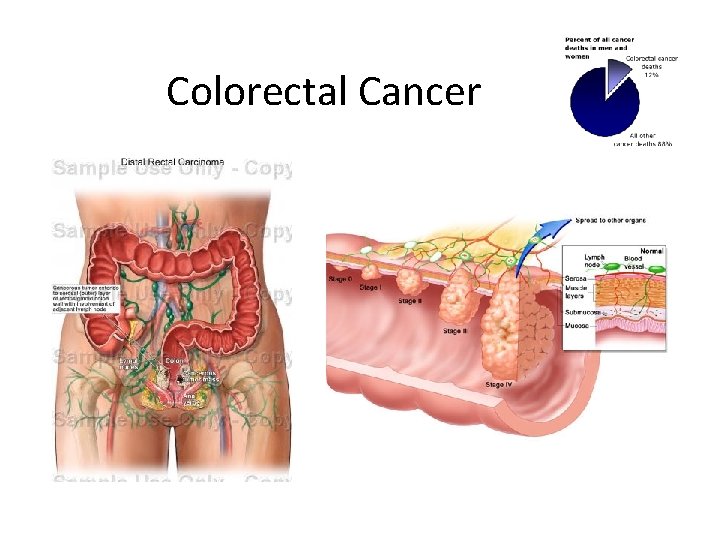 Colorectal Cancer 