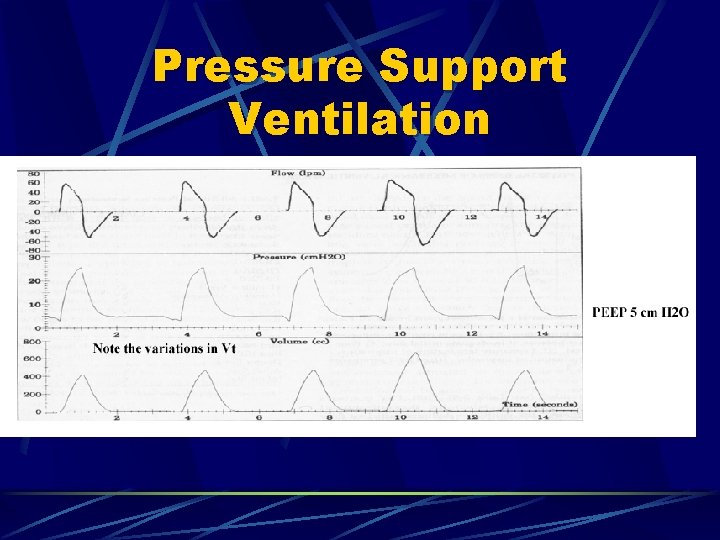 Pressure Support Ventilation 