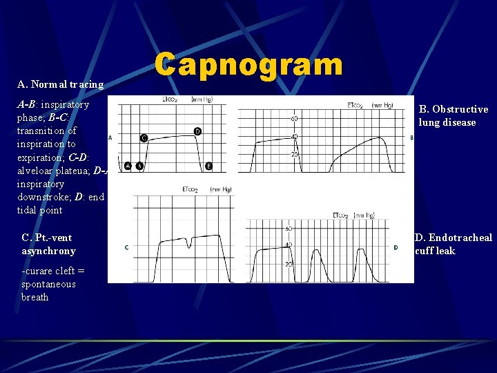 A. Normal tracing A-B: inspiratory phase; B-C: transnition of inspiration to expiration; C-D: alveloar