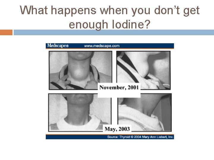 What happens when you don’t get enough Iodine? 