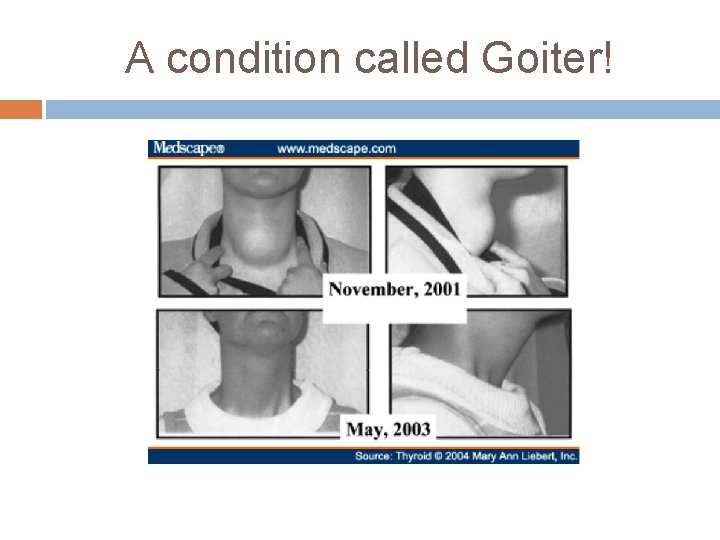 A condition called Goiter! 