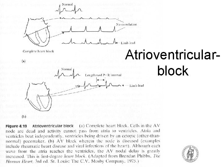 Atrioventricularblock Atrioventricularblock
