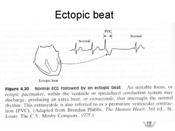 Ectopic beat Ectopic beat