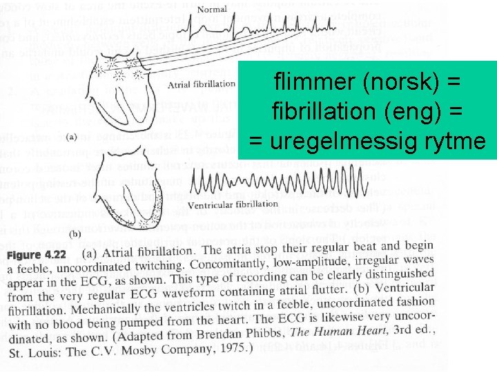 flimmer (norsk) = fibrillation (eng) = = uregelmessig rytme flimmer (norsk) = fibrillation (eng) = = uregelmessig rytme