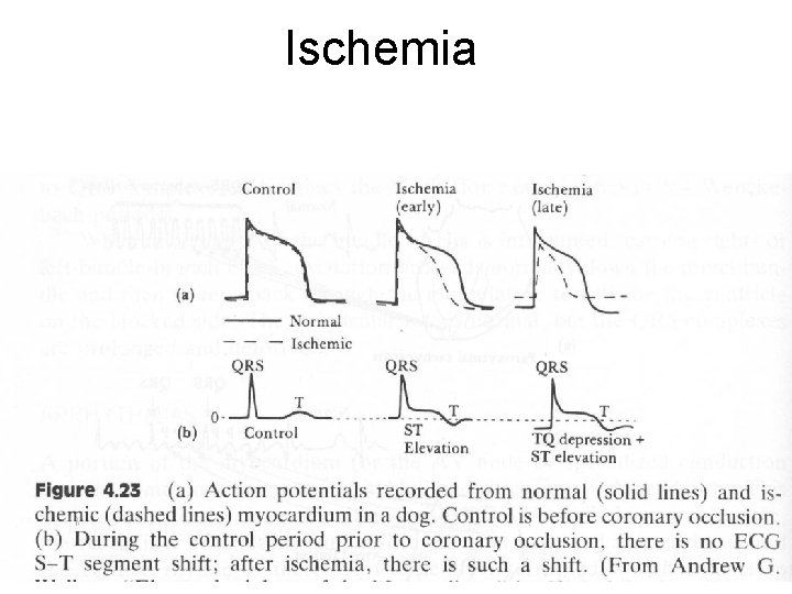 Ischemia Ischemia