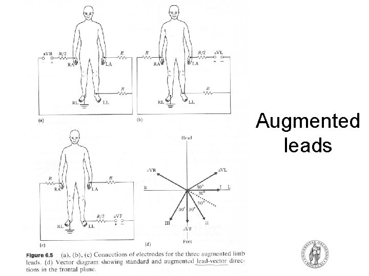 Augmented leads Augmented leads